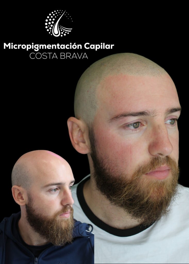 Micropigmentación Capilar Costa Brava