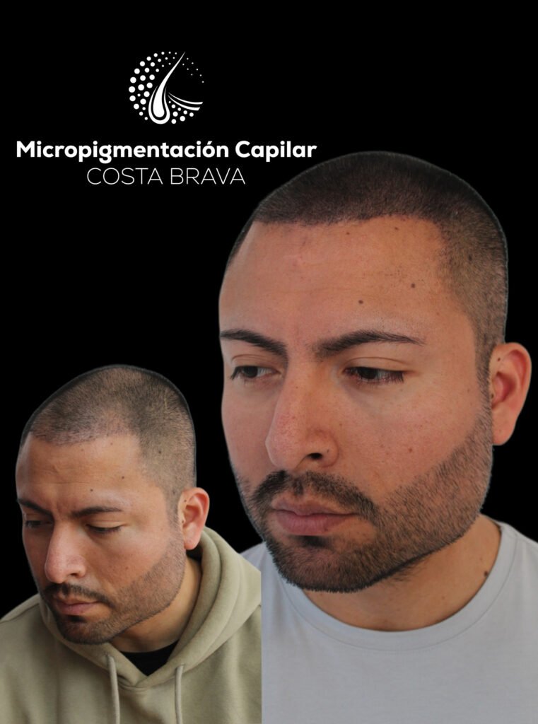 Micropigmentación Capilar Costa Brava