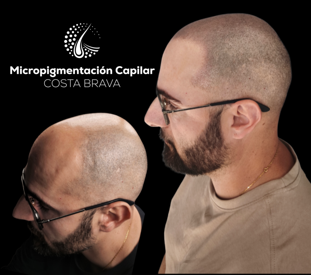 Micropigmentación Capilar Costa Brava